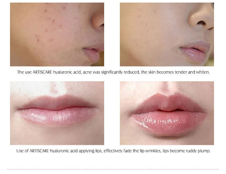 ARTISCARE Vitamin C Serum+Hyaluronic Acid Serum Aging Moisturizing Skin Care Firming Treatment Moisturizing 4PCS